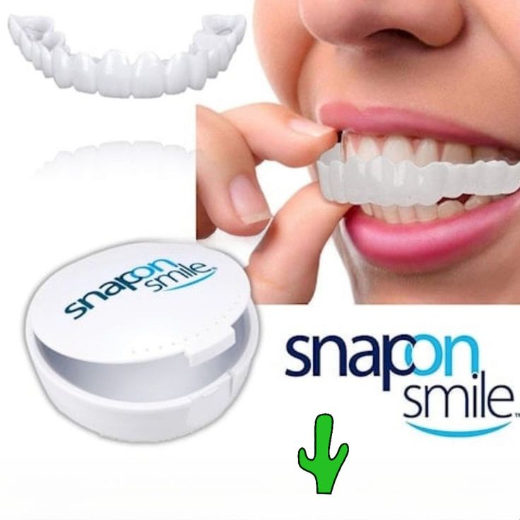 Snap-on Smile teeth