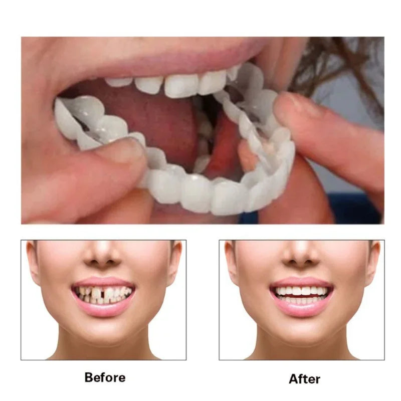 Snap-on Smile teeth