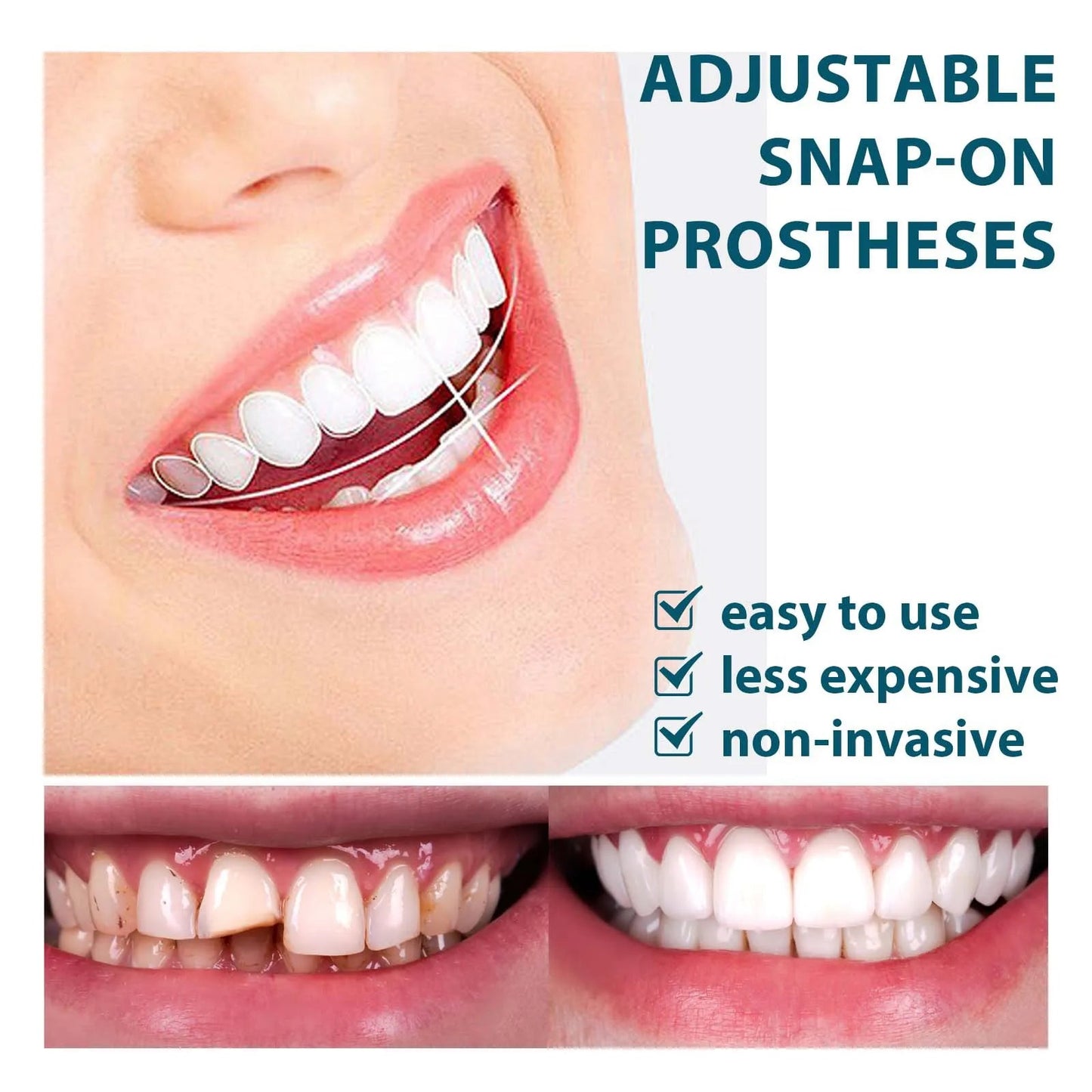Snap-on Smile teeth